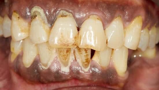 manchas negras en los dientes