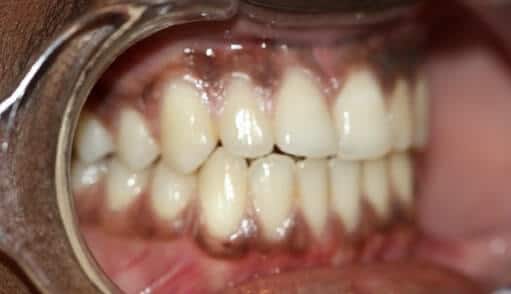 tratamiento para las manchas negras en los dientes