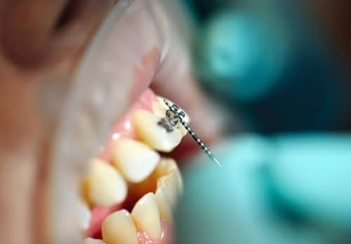 Cómo se ajustan los arcos dentales y con qué frecuencia se deben ajustar
