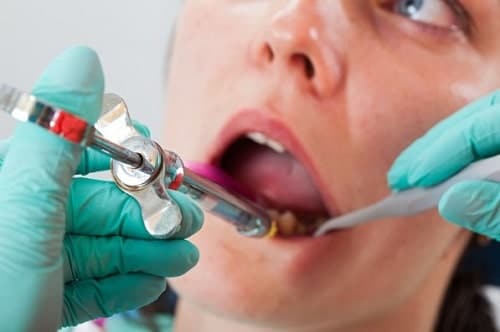 como se aplica la anestesia local en el dentista