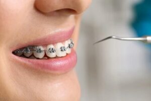 ¿Qué son los arcos dentales y para qué se utilizan?