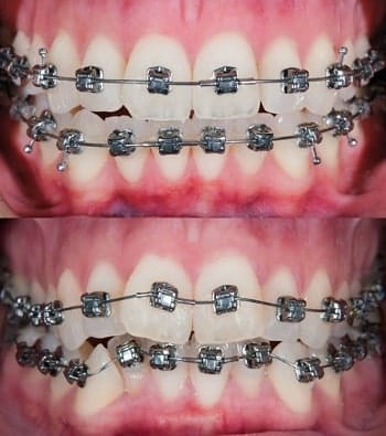 resultados arcos dentales