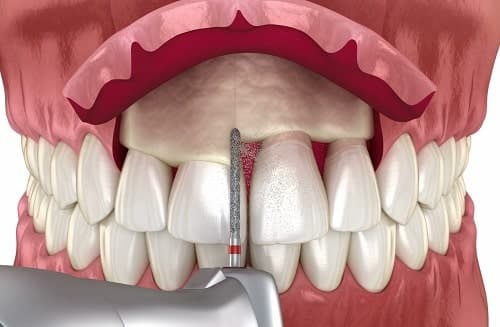 Gingivectomía en tratamientos de estética dental