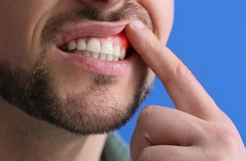 Opiniones de expertos sobre la gingivectomía