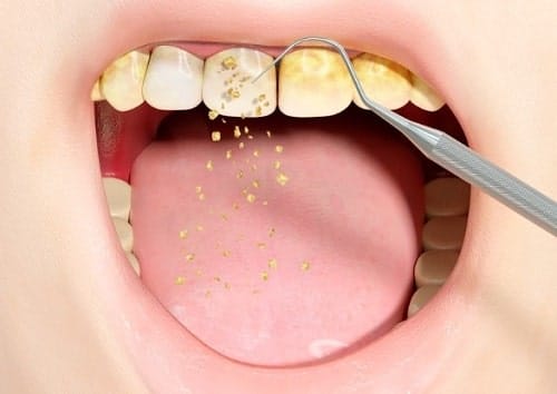 raspado dental
