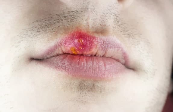 síntomas de herpes labial